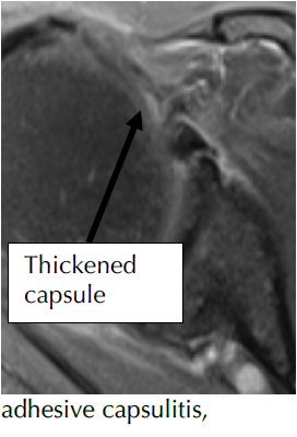 Adhesive Capsulitis