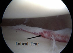 Labral tears