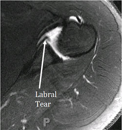 Labral tears