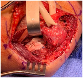 reconstructed ligament