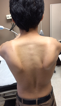 scapular dyskinesis