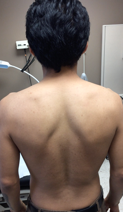 scapular dyskinesis