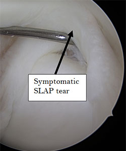 superior labral