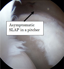 superior labral