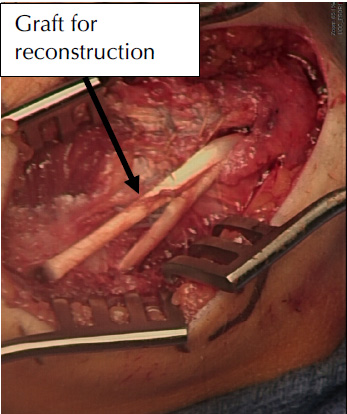 bone ligament attachments