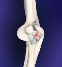 Elbow Ligament Reconstruction