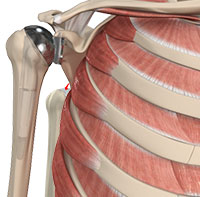 Reverse Total Shoulder Replacement